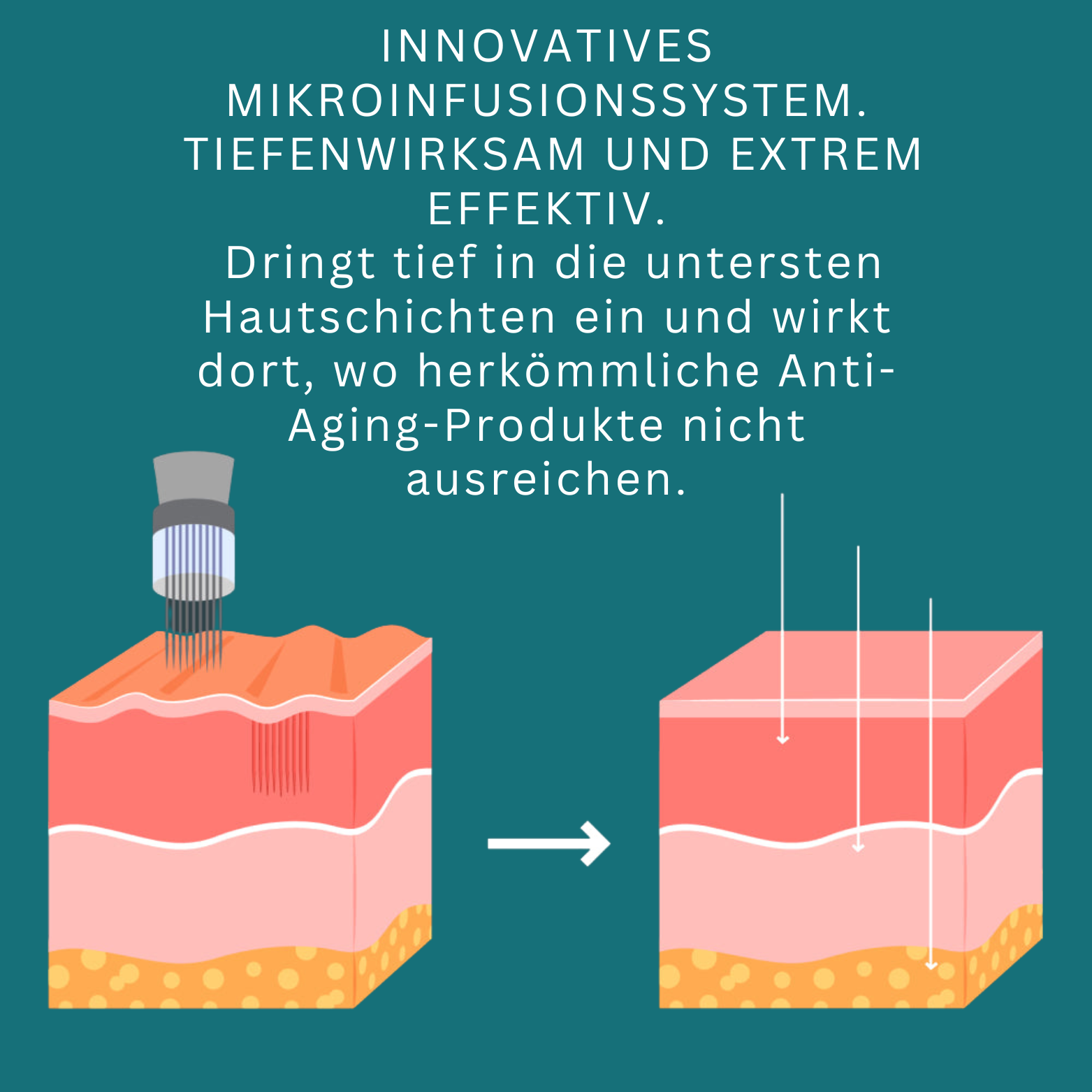 RevitaPen™ Mikro-Infusions-Pen