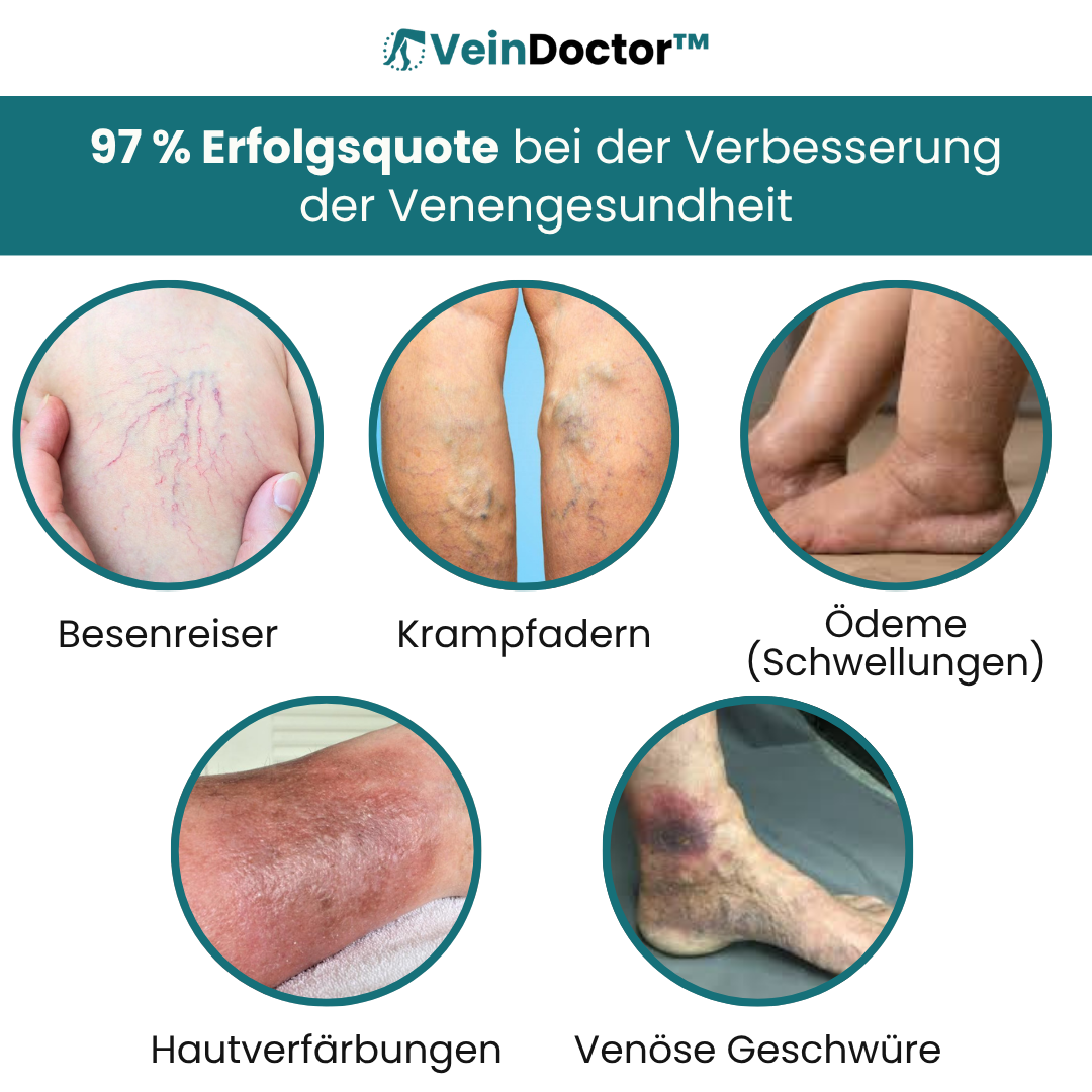 VeinDoctor™ Anti-Krampfader-Creme